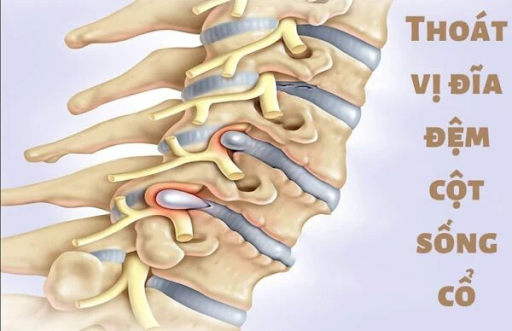 Thoát vị đĩa đệm cột sống cổ cũng là một nguyên nhân